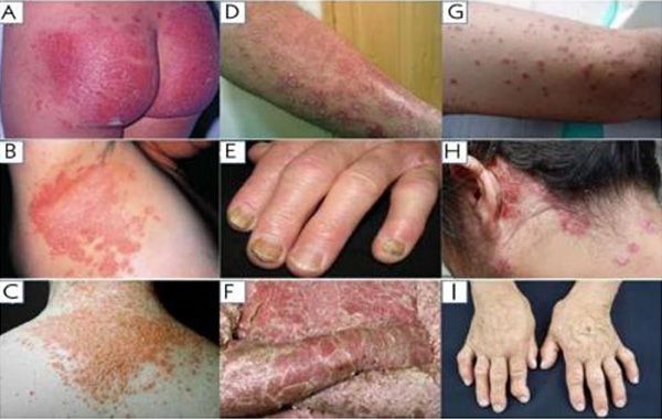 A) Psoríase no glúteo pelo uso de fraldas; B) Psoríase invertida; C) psoríase pustulosa; D) psoríase em placas; E) psoríase ungueal; F) psoríase eritrodérmica; G) Psoríase gutata; H) Psoríase no couro cabeludo; I) Artropatia psoriática nas mãos